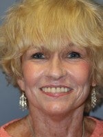 65-74 year old woman treated with Neck Lift after 3103924