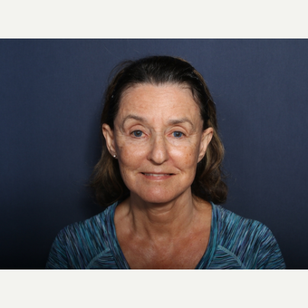 65-74 year old woman treated with Facelift (view 1 of 2) after 3260036