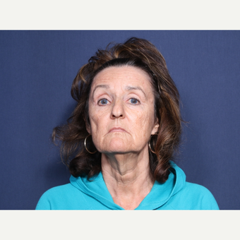 65-74 year old woman treated with Facelift (view 1 of 2) before 3260036