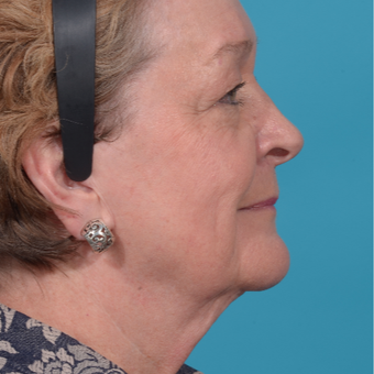 72 year old woman treated with Facelift/necklift, upper eyelid blepharoplasty before 3260376