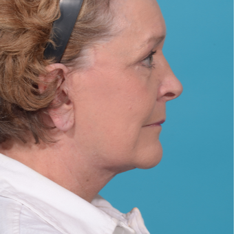 72 year old woman treated with Facelift/necklift, upper eyelid blepharoplasty after 3260376