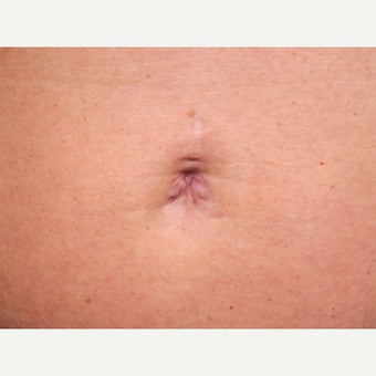 Belly Button Surgery after 1701246