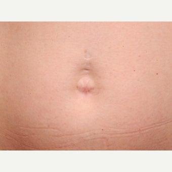 Belly Button Surgery before 1701246