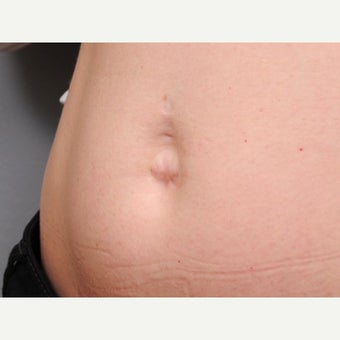 Belly Button Surgery 1701246