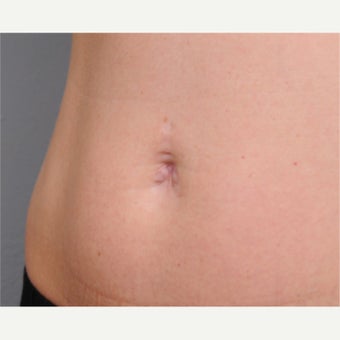 Belly Button Surgery 1701246