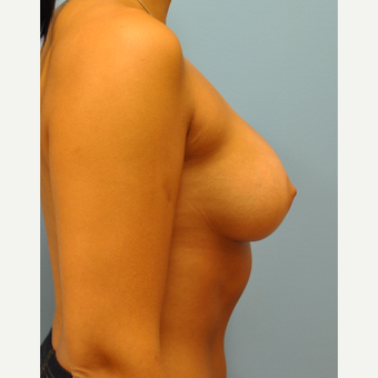 25 year old woman, 325 cc saline moderate profile plus filled to 350 cc- breast augmentation after 3584211