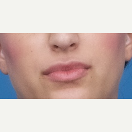25-34 year old woman treated with Restylane Silk after 3764127