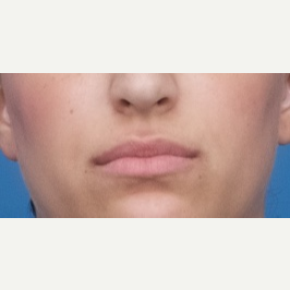 25-34 year old woman treated with Restylane Silk before 3764127