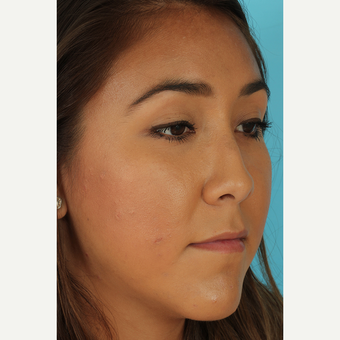 25-34 year old woman treated with Rhinoplasty before 3690852