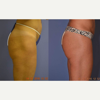 45-54 year old woman treated with Ultherapy before 3121896