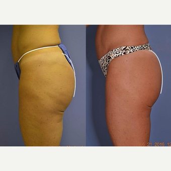45-54 year old woman treated with Ultherapy after 3121896