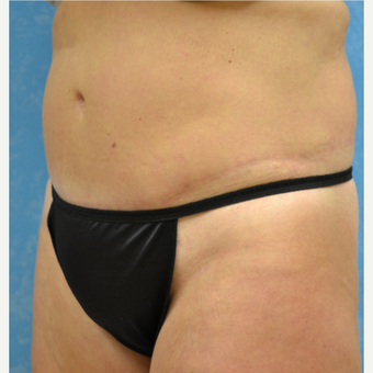 35-44 year old woman treated with Tummy Tuck after 3732045