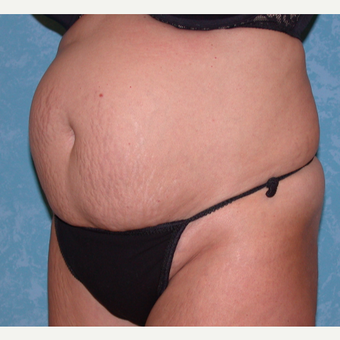 35-44 year old woman treated with Tummy Tuck before 3732045