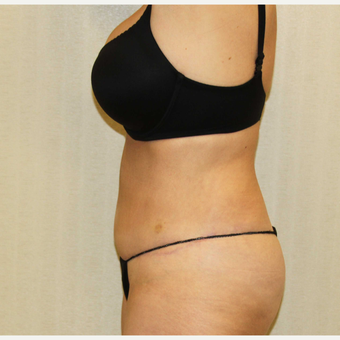 55-64 Year Old Woman Treated with Tummy Tuck to treat Excess Skin and Fat in Abdominal Region after 2988695
