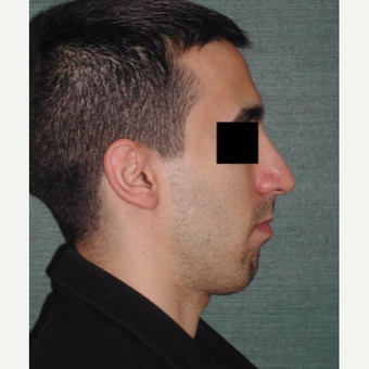 25-34 year old man treated with Rhinoplasty after 3059538