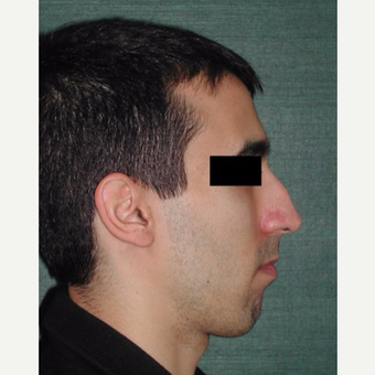 25-34 year old man treated with Rhinoplasty before 3059538