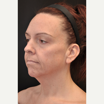 Facelift before 2058588