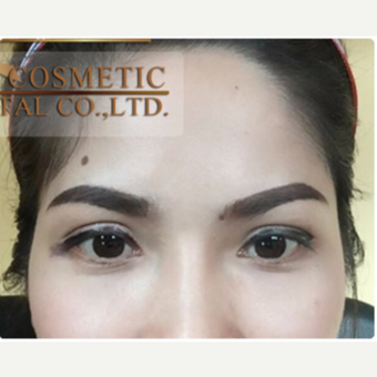 35-44 year old woman treated with Eyelid Surgery after 3761044