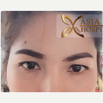35-44 year old woman treated with Eyelid Surgery before 3761044