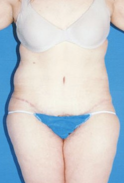 Circumferential Tuck after 863786