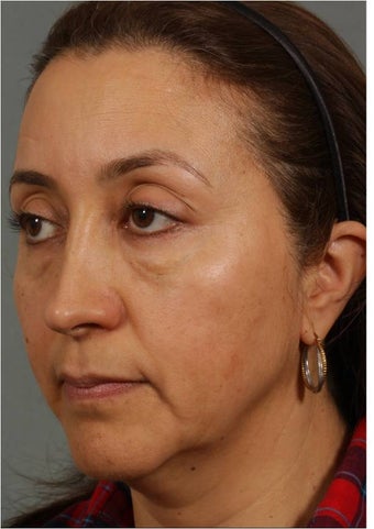 50 Year old Female with volume loss and sagging under her eyes, cheeks and jawline before 929549