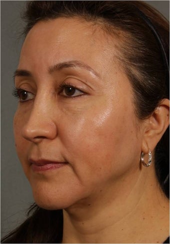 50 Year old Female with volume loss and sagging under her eyes, cheeks and jawline after 929549