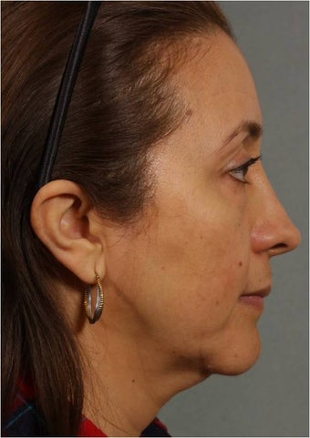 50 Year old Female with volume loss and sagging under her eyes, cheeks and jawline 929549