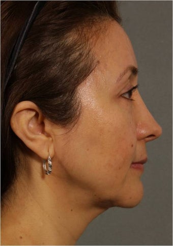 50 Year old Female with volume loss and sagging under her eyes, cheeks and jawline 929549