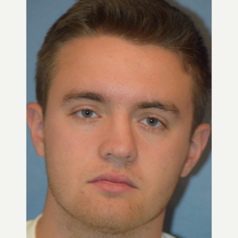 18-24 year old man treated with Rhinoplasty before 3245912