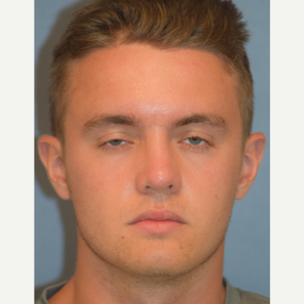 18-24 year old man treated with Rhinoplasty after 3245912