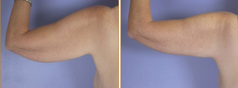 Arm Lift before 272271