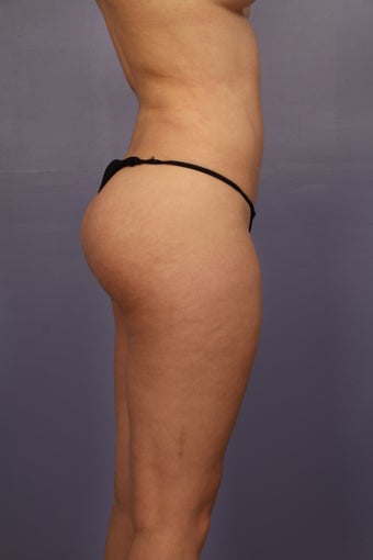 Revision Brazilian Butt Lift before 1374531