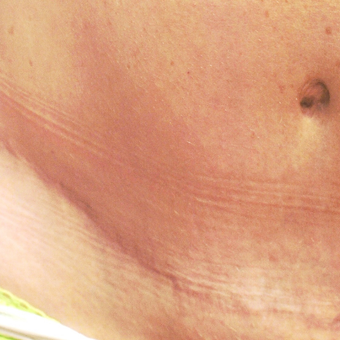 25-34 year old woman treated with Scars Treatment after 3202140