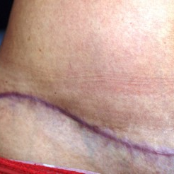 25-34 year old woman treated with Scars Treatment before 3202140