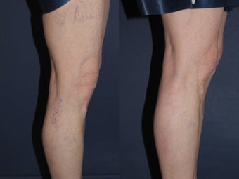 Sclerotherapy For Leg Veins before 1033904