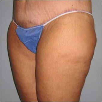 37 year old woman treated with Body Lift after 3680210