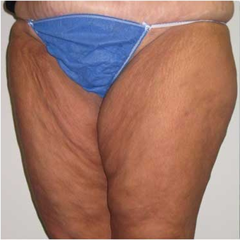37 year old woman treated with Body Lift before 3680210