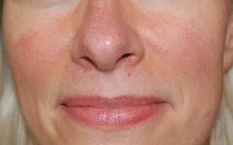 Laser treatment for facial veins and redness before 732817
