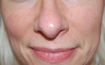 Laser treatment for facial veins and redness after 732817