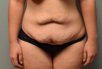 18-24 year old woman treated with Tummy Tuck before 3076852