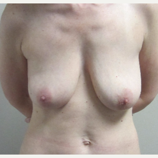 45 year old woman treated with Breast Lift before 3482520