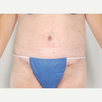 35-44 year old woman treated with Body Lift after 1661469