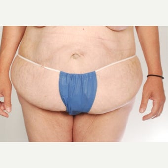 35-44 year old woman treated with Body Lift before 1661469