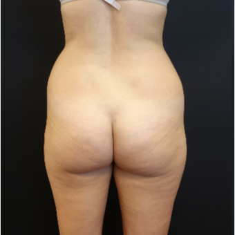 25-34 year old woman treated with Butt Augmentation before 3629846