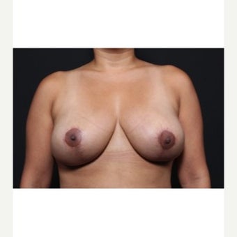 25-34 year old woman treated with Breast Implant Removal after 1872282