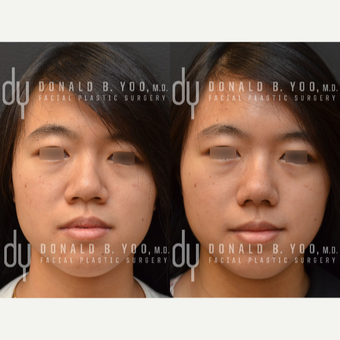 Asian Rhinoplasty with Rib cartilage before 3622577