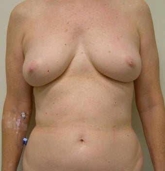 61-year-old female with left nipple-sparing immediate DIEP breast reconstruction through inframammary incision before 698994