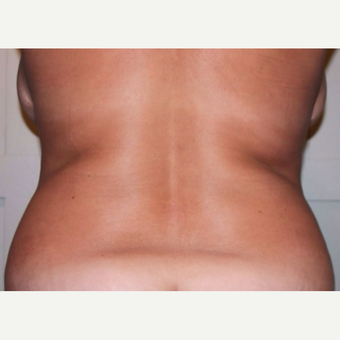 CoolSculpting Successfully Takes on Bra Roll and Love Handles before 2056989