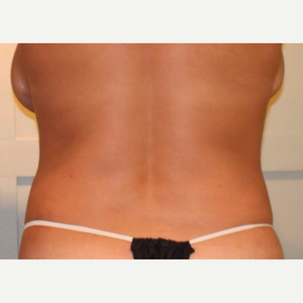 CoolSculpting Successfully Takes on Bra Roll and Love Handles after 2056989