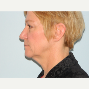 55-64 year old woman treated with Facelift before 3266373